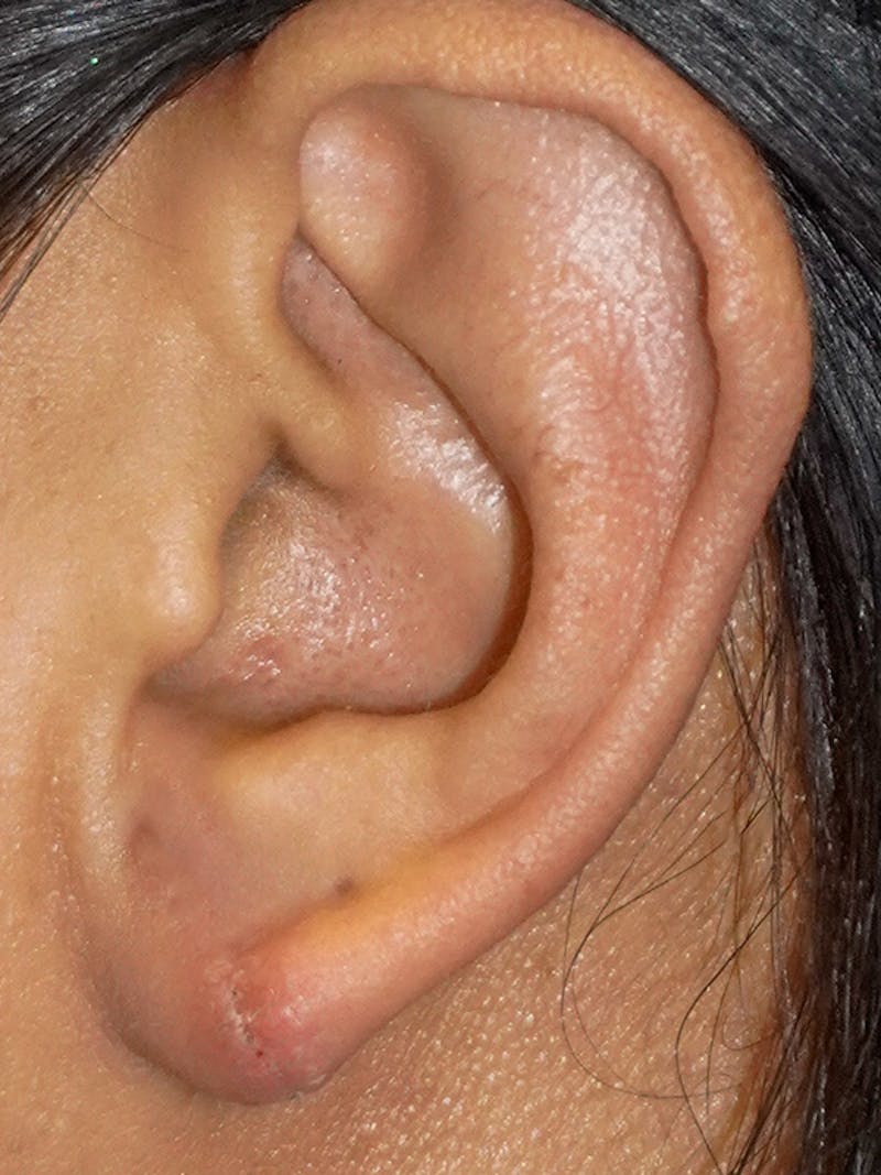 Earlobe Repair Before & After Gallery - Patient 269878 - Image 2