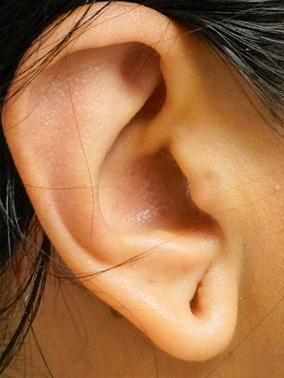 Earlobe Repair Before & After Gallery - Patient 748072 - Image 1
