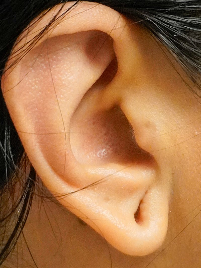 Earlobe Repair Before & After Gallery - Patient 748072 - Image 1
