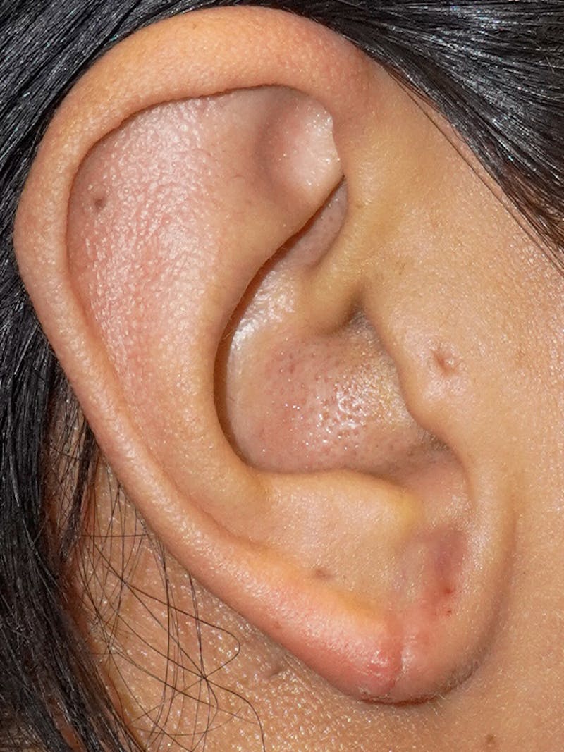 Earlobe Repair Before & After Gallery - Patient 748072 - Image 2