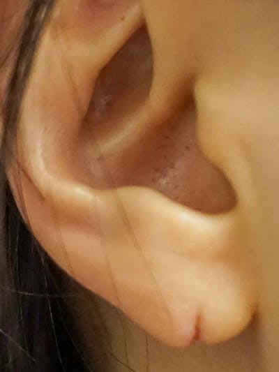 Earlobe Repair Before & After Gallery - Patient 191276 - Image 1