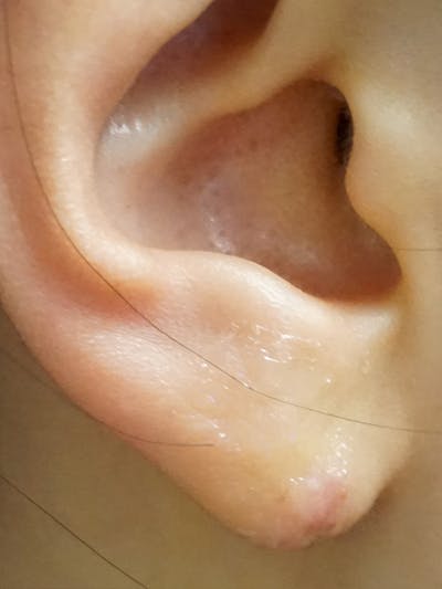 Earlobe Repair Before & After Gallery - Patient 191276 - Image 2