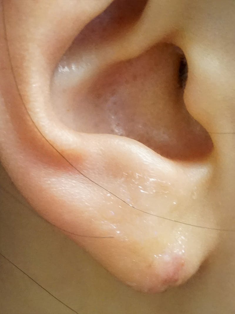 Earlobe Repair Before & After Gallery - Patient 191276 - Image 2