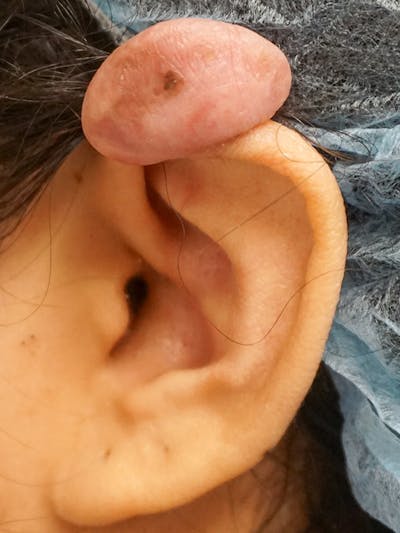 Ear Keloid Repair Before & After Gallery - Patient 374371 - Image 1