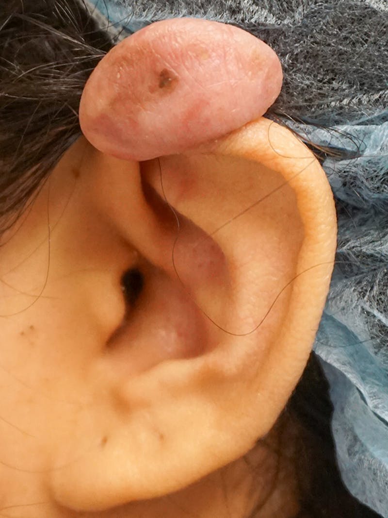 Ear Keloid Repair Before & After Gallery - Patient 374371 - Image 1