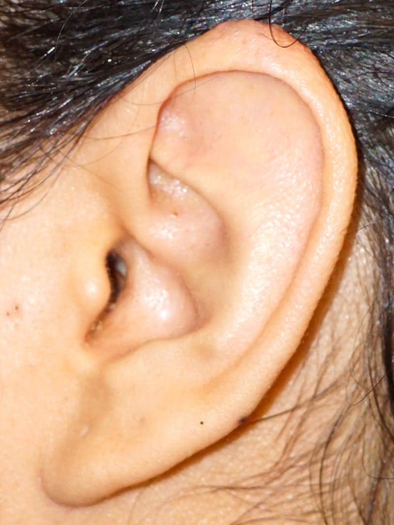 Ear Keloid Repair Before & After Gallery - Patient 374371 - Image 2
