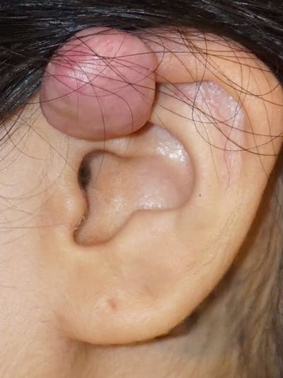 Ear Keloid Repair Before & After Gallery - Patient 299827 - Image 1