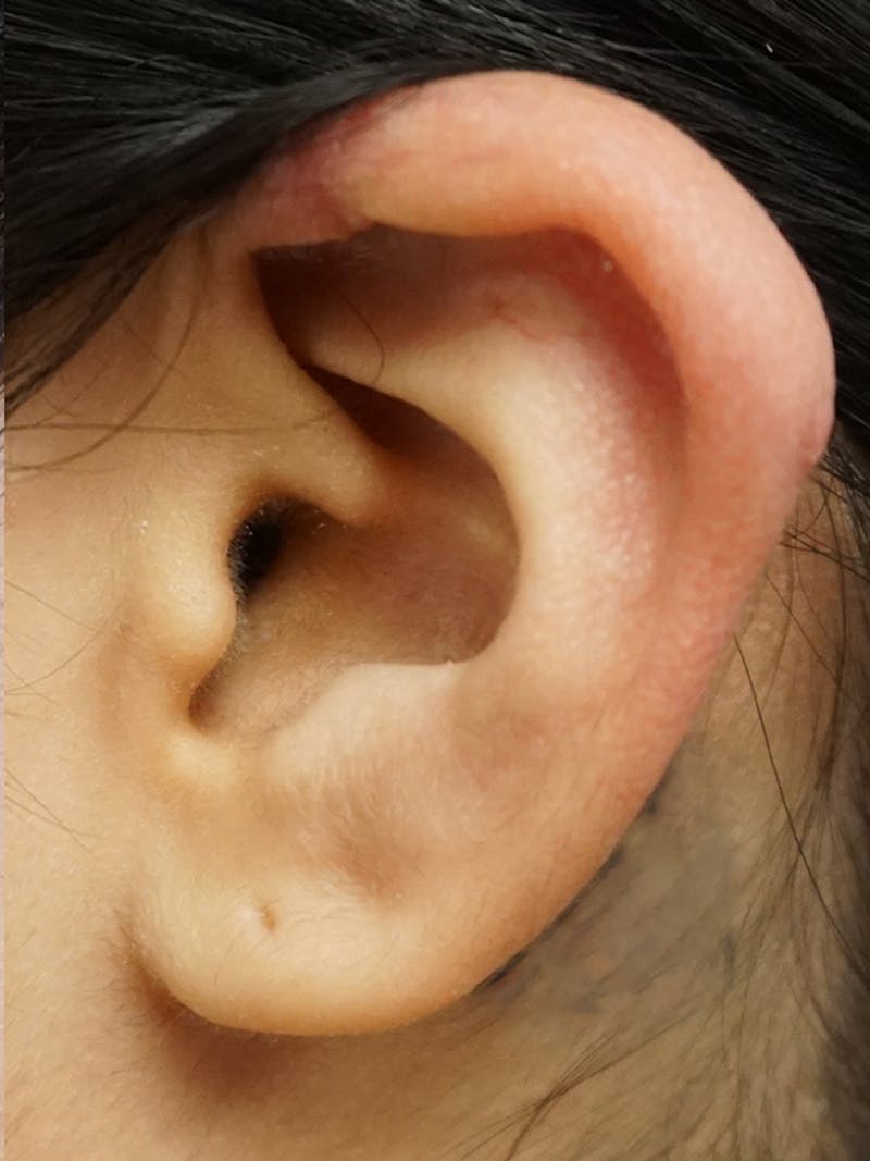 Ear Keloid Repair Before & After Gallery - Patient 299827 - Image 2