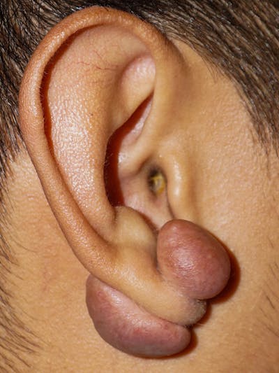 Ear Keloid Repair Before & After Gallery - Patient 404786 - Image 1