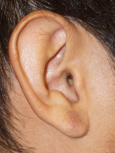 Ear Keloid Repair Before & After Gallery - Patient 404786 - Image 2