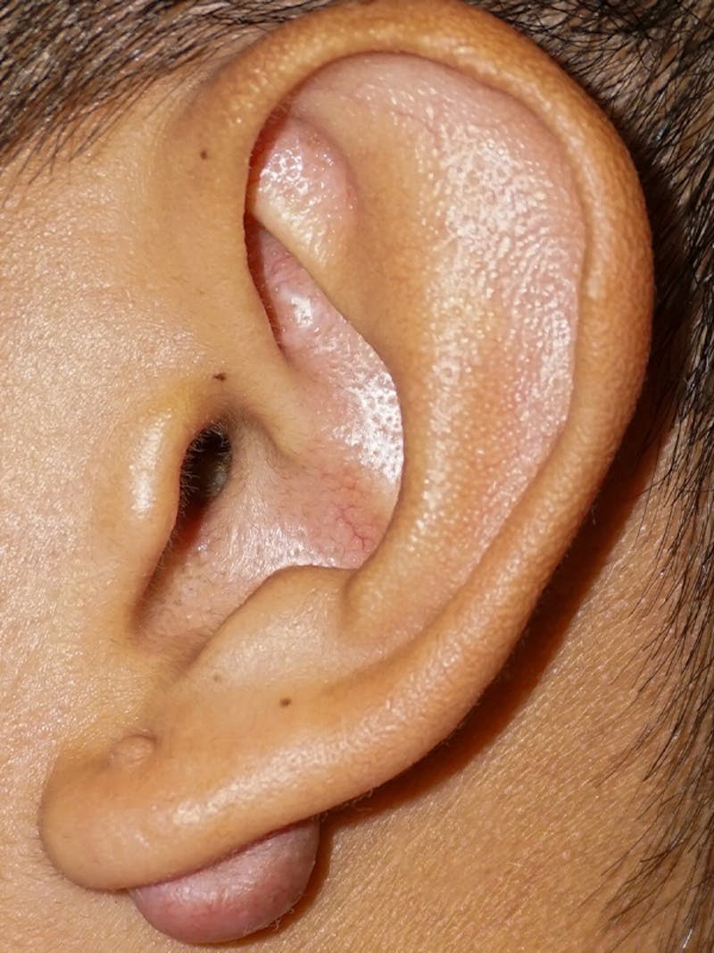 Ear Keloid Repair Before & After Gallery - Patient 192513 - Image 1