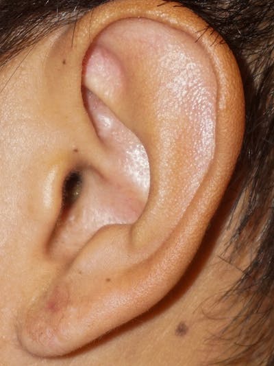 Ear Keloid Repair Before & After Gallery - Patient 192513 - Image 2