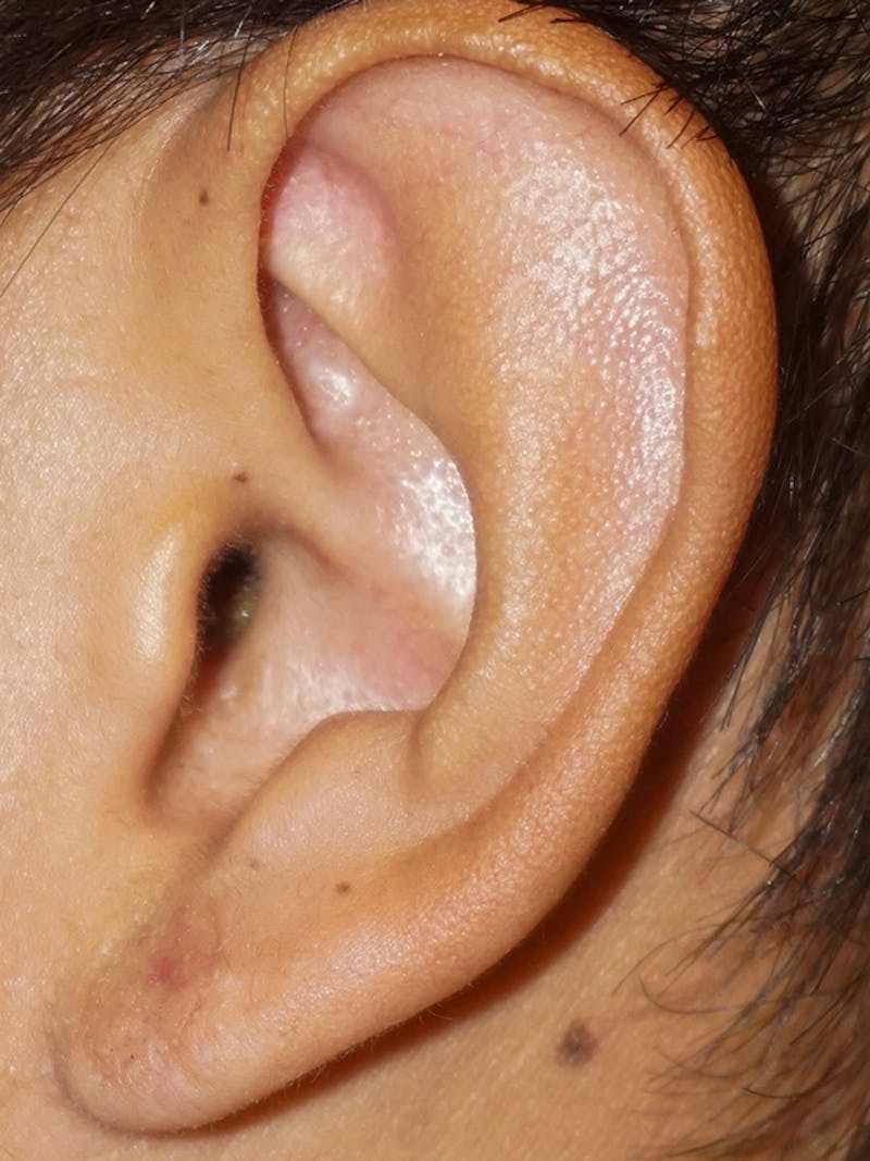 Ear Keloid Repair Before & After Gallery - Patient 192513 - Image 2