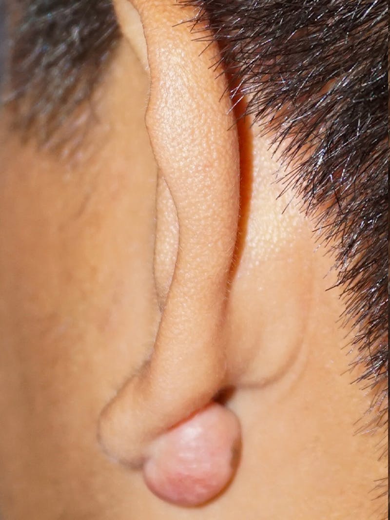 Ear Keloid Repair Before & After Gallery - Patient 192513 - Image 3
