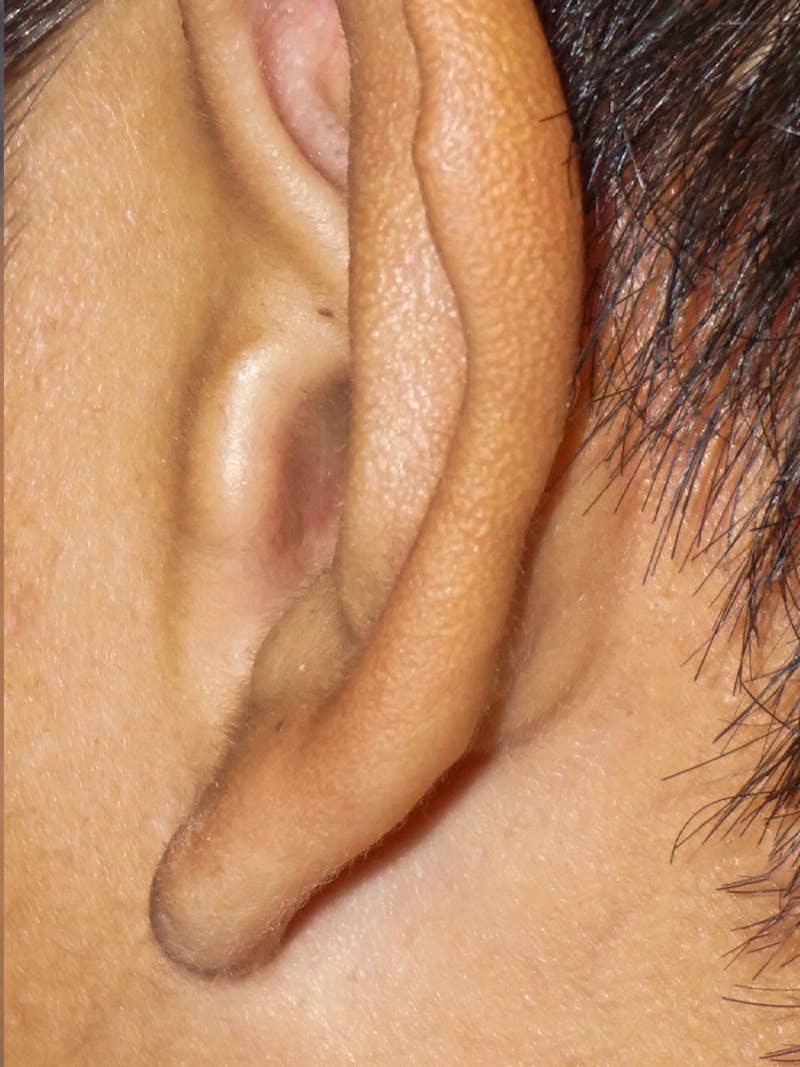Ear Keloid Repair Before & After Gallery - Patient 192513 - Image 4