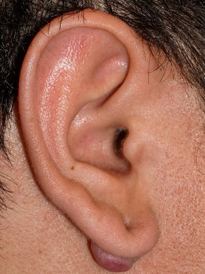 Ear Keloid Repair Before & After Gallery - Patient 418310 - Image 1