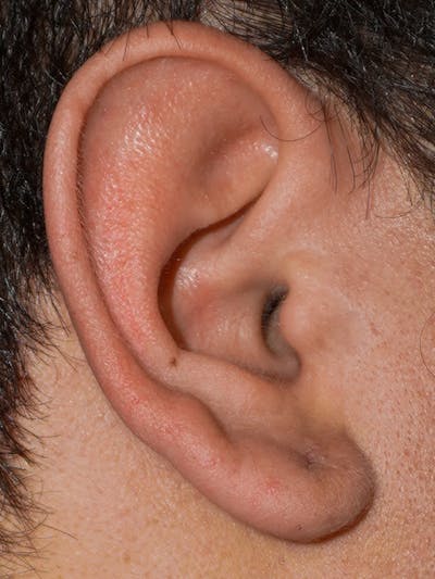 Ear Keloid Repair Before & After Gallery - Patient 418310 - Image 2