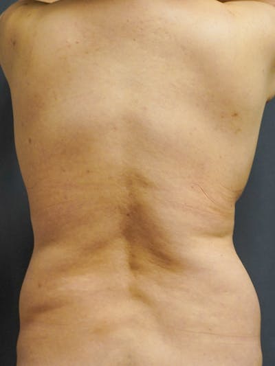 Liposuction Before & After Gallery - Patient 350951 - Image 1
