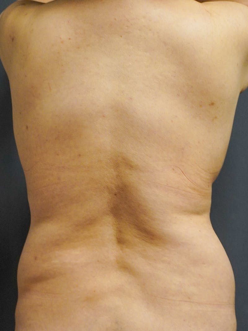 Liposuction Before & After Gallery - Patient 350951 - Image 1