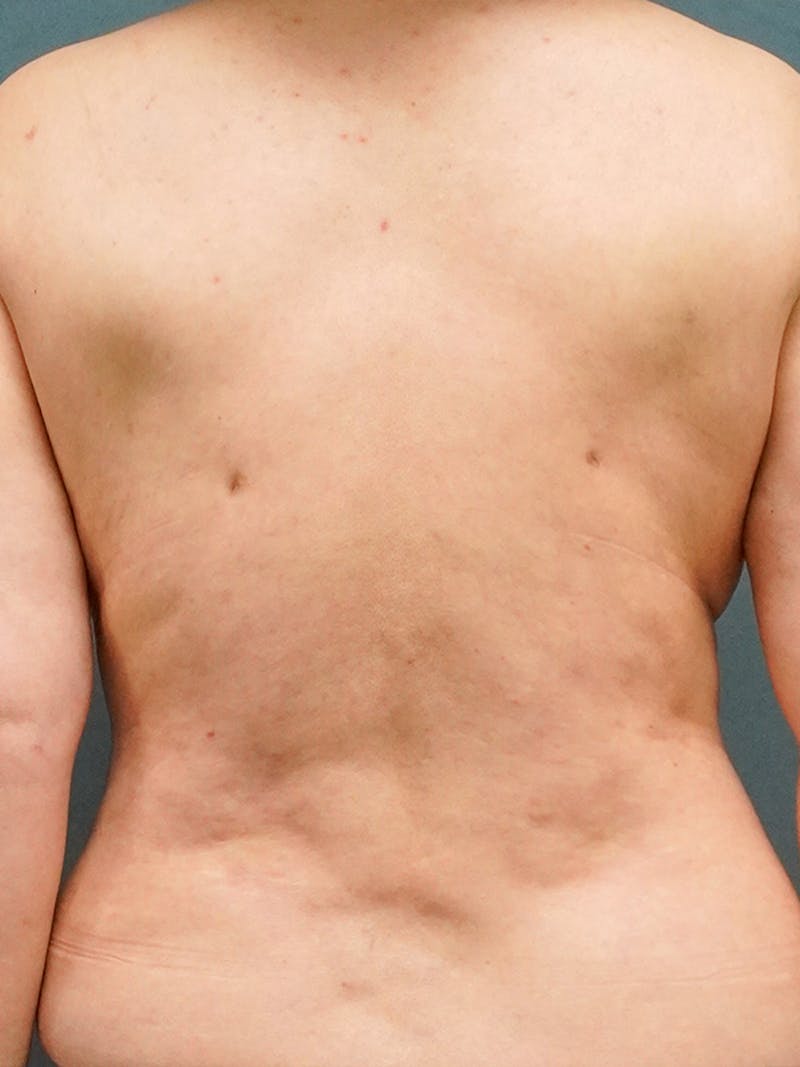 Liposuction Before & After Gallery - Patient 350951 - Image 2