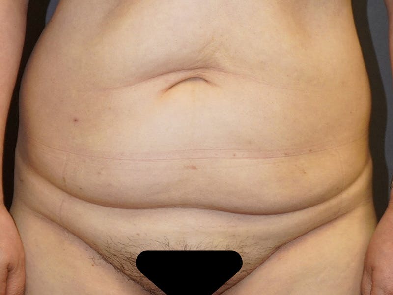 Tummy Tuck Before & After Gallery - Patient 253311 - Image 1