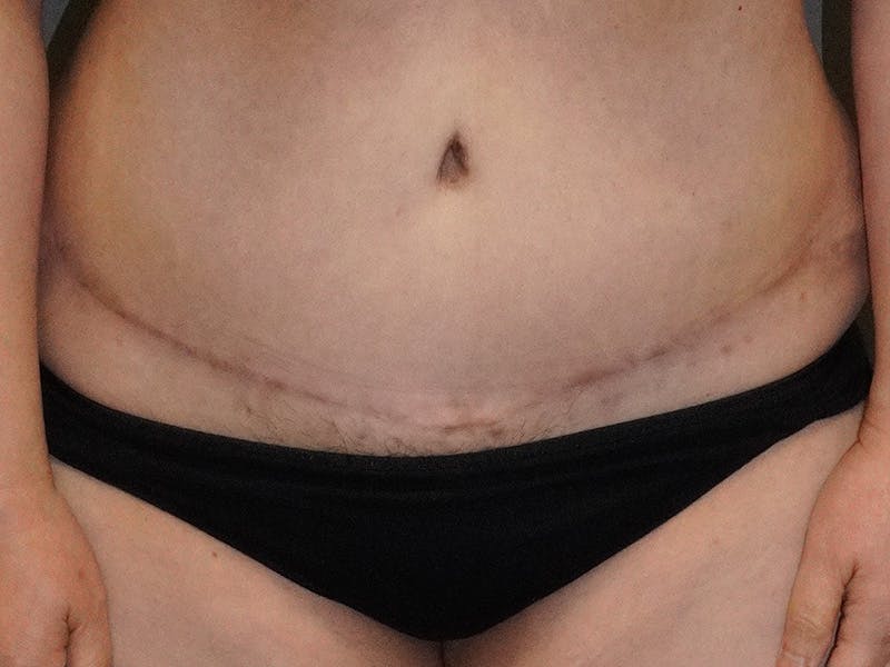 Tummy Tuck Before & After Gallery - Patient 253311 - Image 2