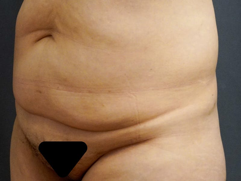 Tummy Tuck Before & After Gallery - Patient 253311 - Image 3