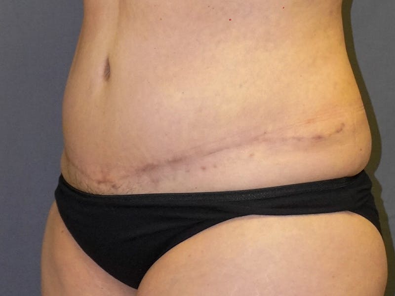 Tummy Tuck Before & After Gallery - Patient 253311 - Image 4