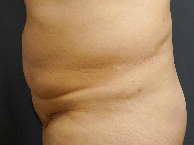 Tummy Tuck Before & After Gallery - Patient 253311 - Image 5