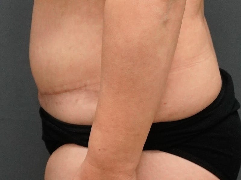 Tummy Tuck Before & After Gallery - Patient 253311 - Image 6