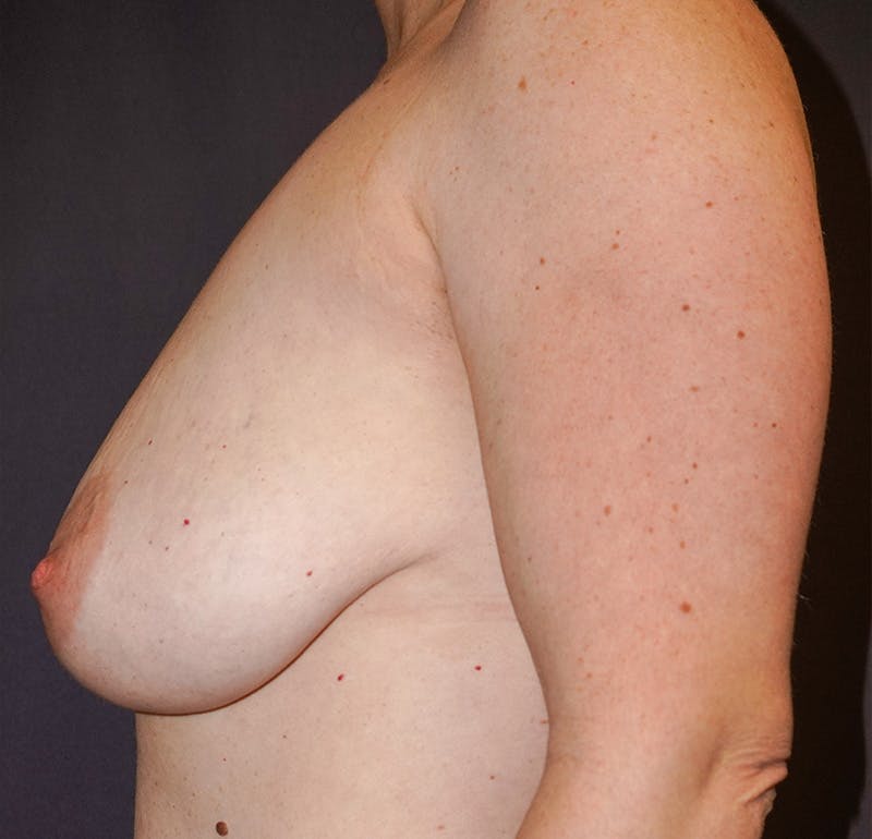Breast Lift Before & After Gallery - Patient 415757 - Image 5