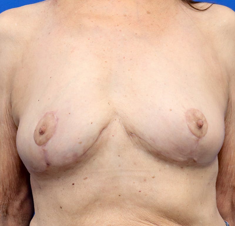 Breast Lift Before & After Gallery - Patient 360534 - Image 2