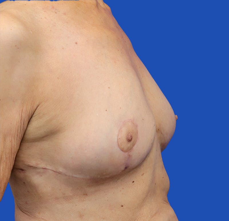 Breast Lift Before & After Gallery - Patient 360534 - Image 4