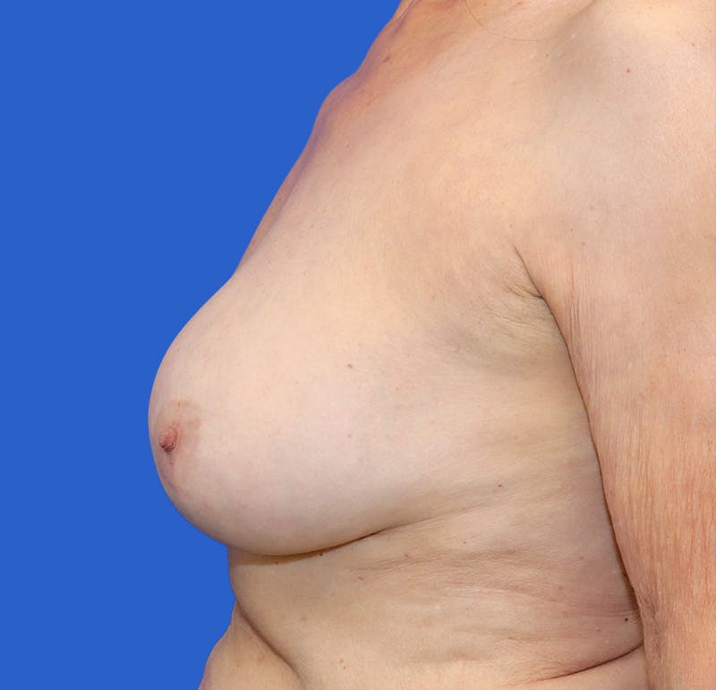 Breast Lift Before & After Gallery - Patient 360534 - Image 5