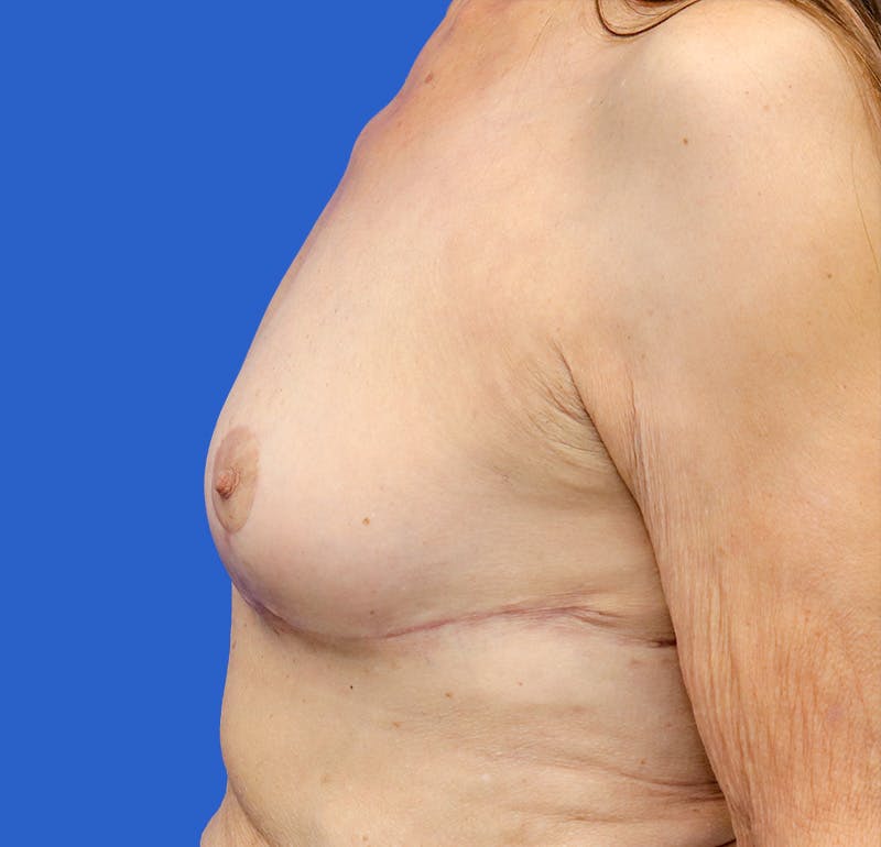Breast Lift Before & After Gallery - Patient 360534 - Image 6