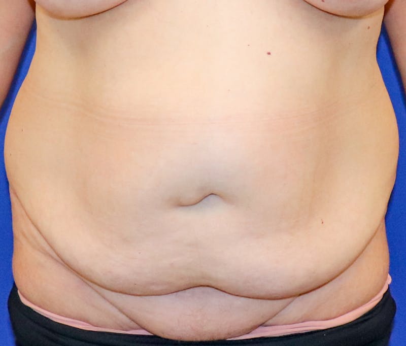 Tummy Tuck Before & After Gallery - Patient 243517 - Image 1