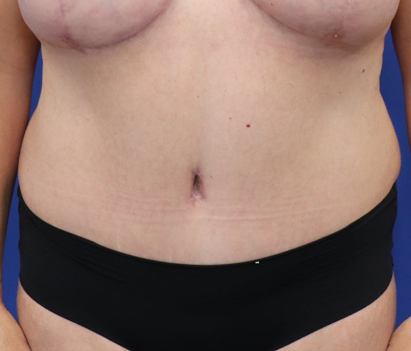 Tummy Tuck Before & After Gallery - Patient 243517 - Image 2