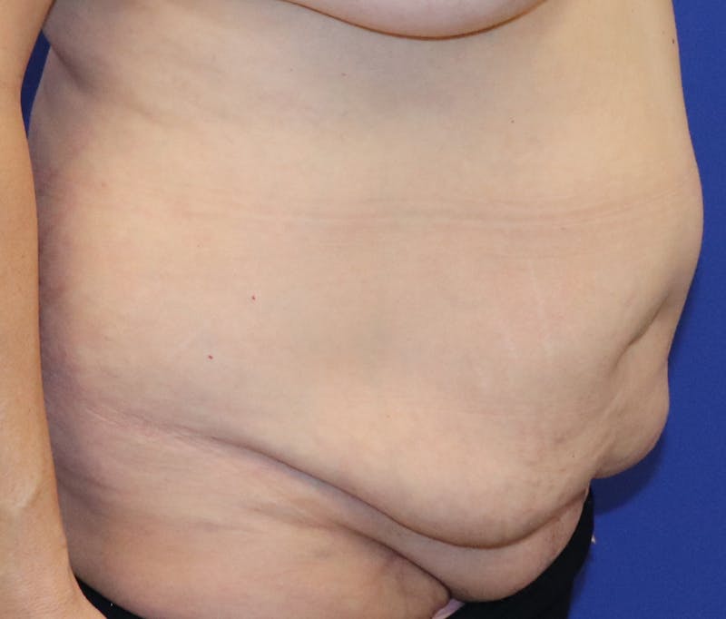 Tummy Tuck Before & After Gallery - Patient 243517 - Image 3