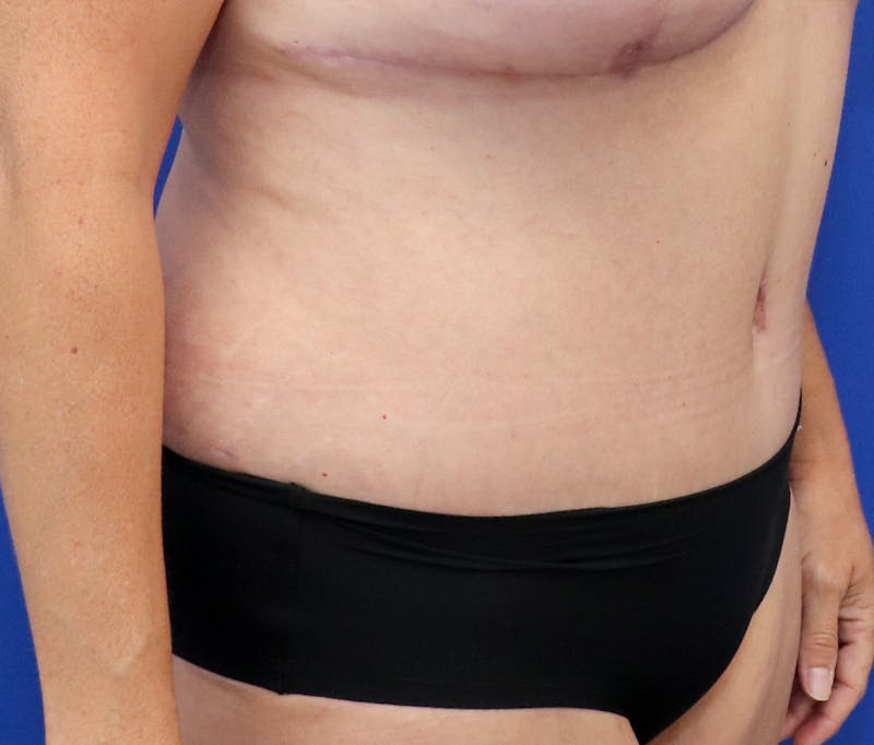 Tummy Tuck Before & After Gallery - Patient 243517 - Image 4