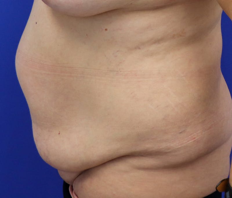 Tummy Tuck Before & After Gallery - Patient 243517 - Image 5