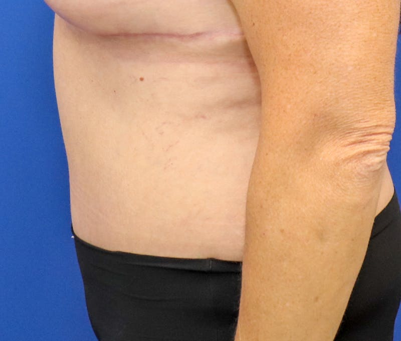Tummy Tuck Before & After Gallery - Patient 243517 - Image 6