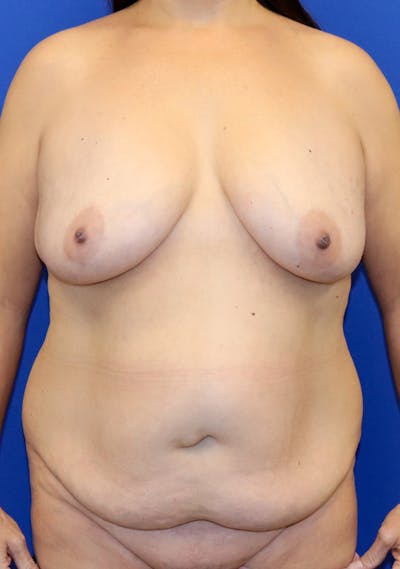 Mommy Makeover Before & After Gallery - Patient 245256 - Image 1
