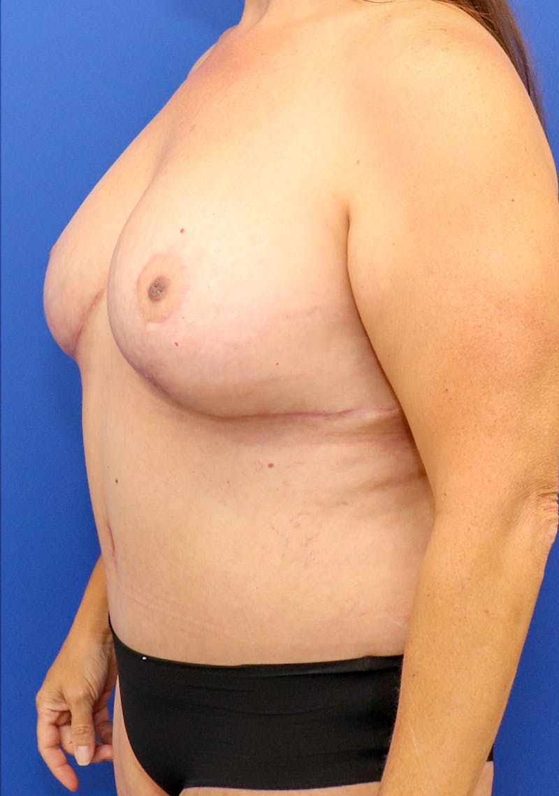 Mommy Makeover Before & After Gallery - Patient 245256 - Image 4