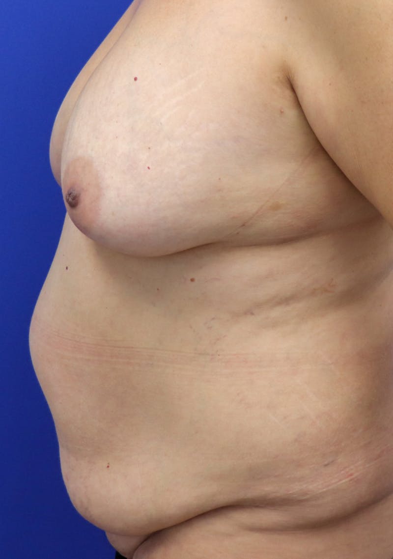 Mommy Makeover Before & After Gallery - Patient 245256 - Image 5