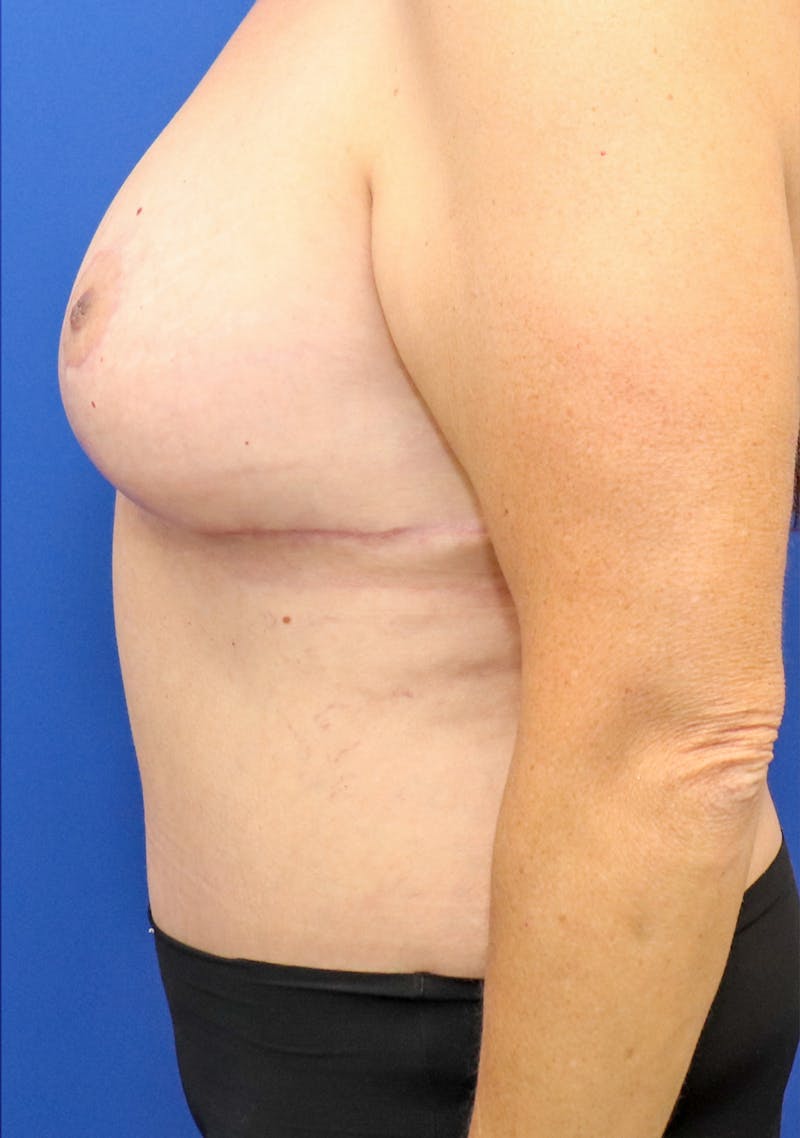 Mommy Makeover Before & After Gallery - Patient 245256 - Image 6