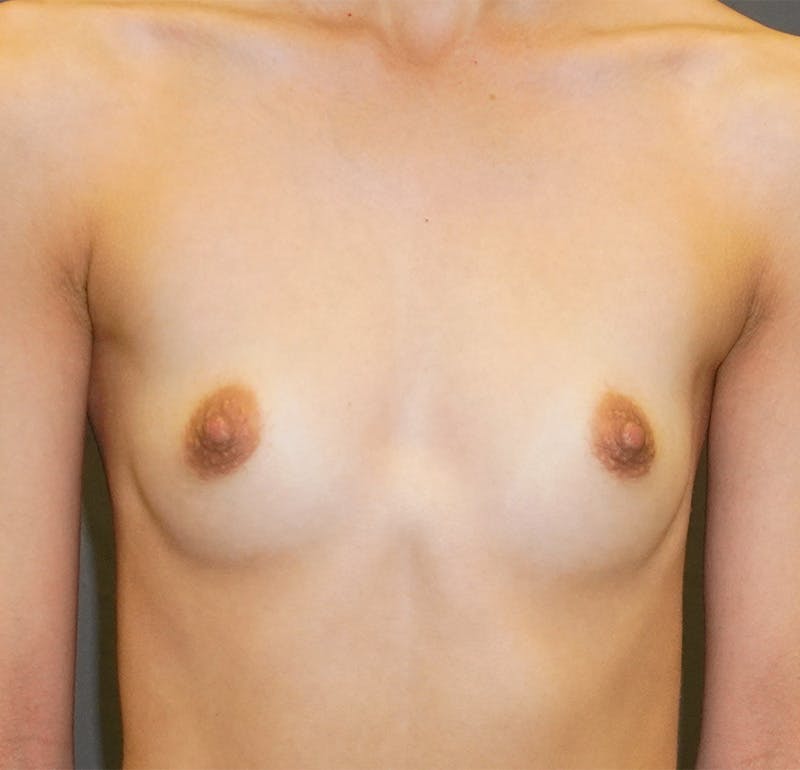 Breast Augmentation Before & After Gallery - Patient 267374 - Image 1