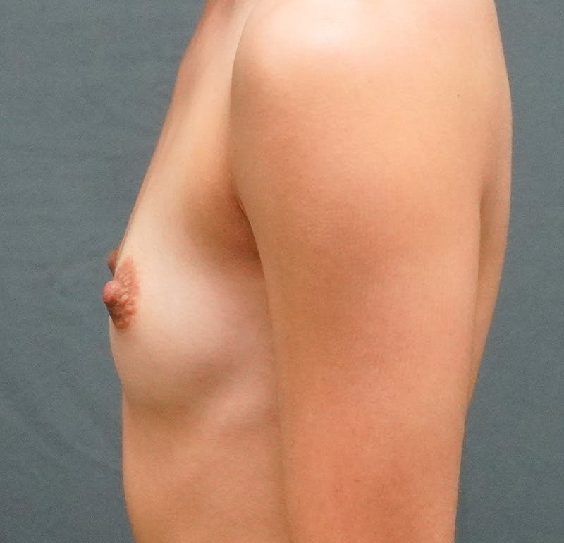 Breast Augmentation Before & After Gallery - Patient 267374 - Image 5
