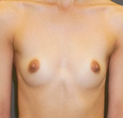 Breast Augmentation Before & After Gallery - Patient 267374 - Image 1