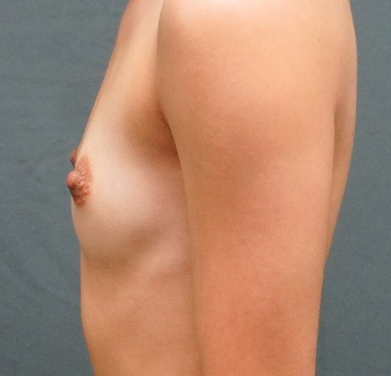Breast Augmentation Before & After Gallery - Patient 267374 - Image 5