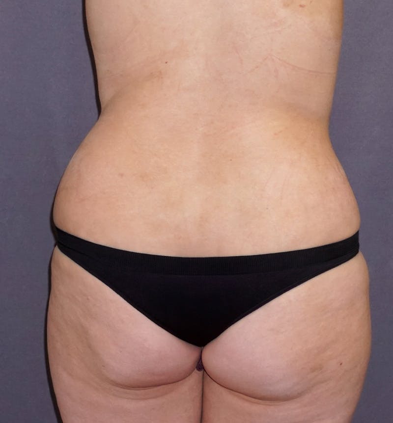 Liposuction Before & After Gallery - Patient 238629 - Image 5